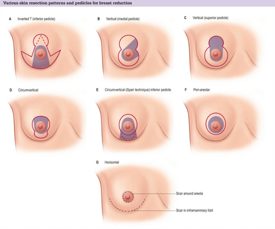 Breast Reduction Before and After: The Procedure, Insurance Coverage, and  Recovery